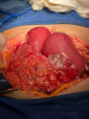 Tumoraciones y adenopatías en intestino delgado